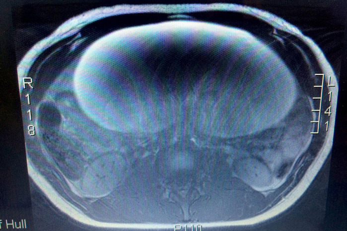 El scanner reveló el gigante tumor en el cuerpo de Olivia