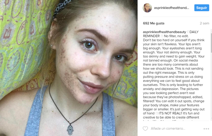 El antes y el después de una joven que sufría de acné: ahora es inspiración para muchas mujeres - Imagen 2