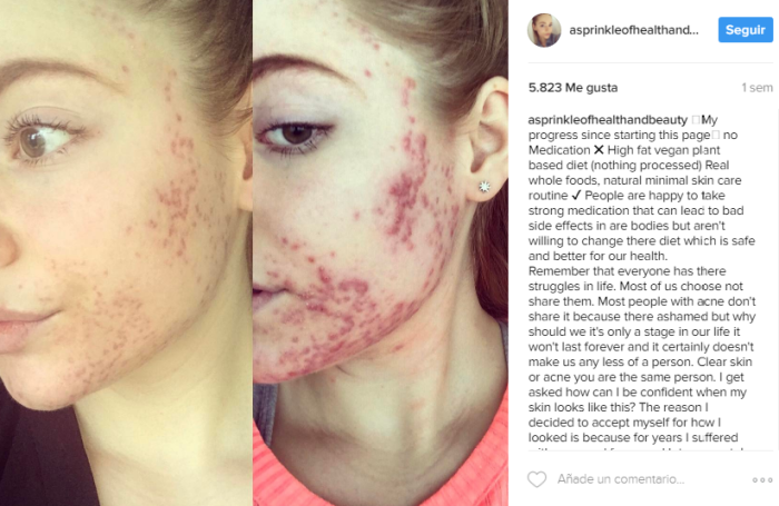 El antes y el después de una joven que sufría de acné: ahora es inspiración para muchas mujeres - Imagen 1