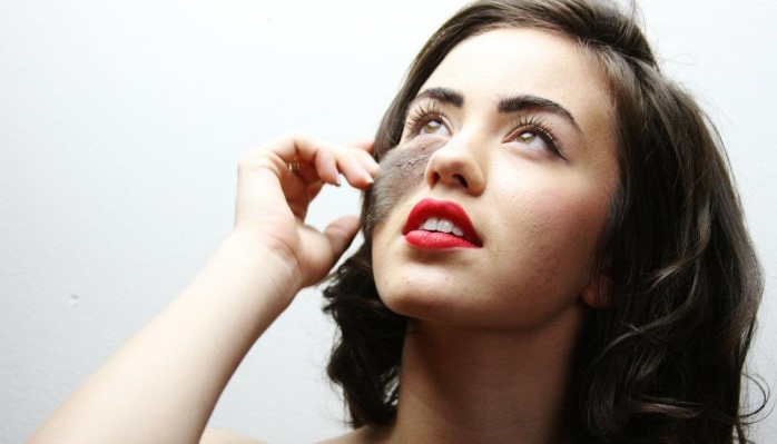 Se reían de ella por su marca de nacimiento: Hoy es una exitosa bailarina profesional