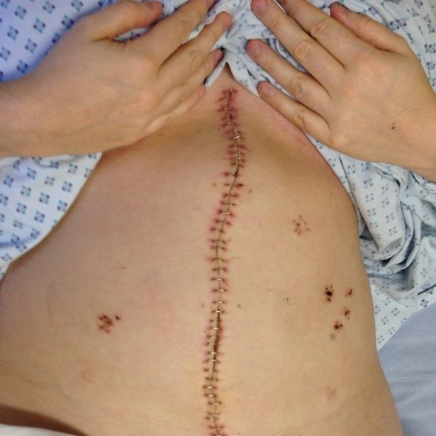dinámica Educación rosado Increíble! Mujer inglesa se somete a cirugía y le extirpan 10 órganos |  Sociedad | Página 7