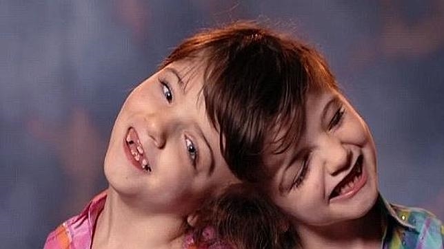 Emotivo caso de siamesas: Logran vivir felices a pesar de su condición