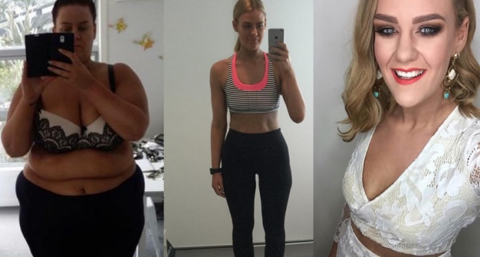 La cirugía que transformó a mujer que bajó 85 kilos: Sufría por exceso de piel