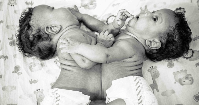 El increíble antes y después de siamesas unidas por el vientre tras cirugía