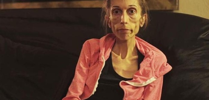 La increíble recuperación de mujer con anorexia que llegó a pesar 27 kilos