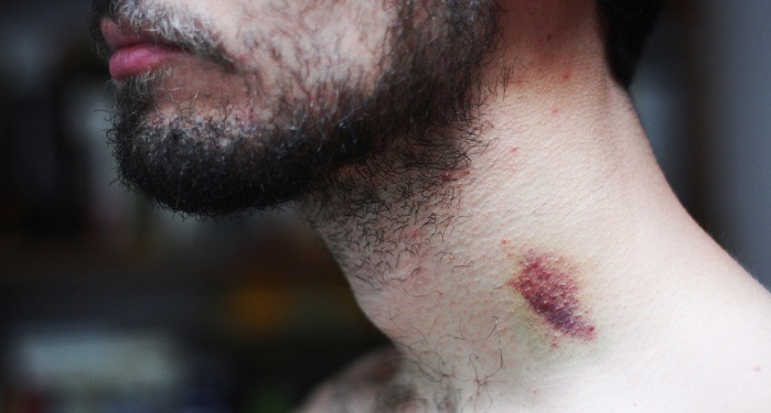 ¿Noche sexy? Esta es la verdadera solución para los vergonzosos 