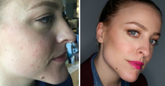 Esta mujer logró acabar con su acné renunciando a un sencillo alimento: lácteos