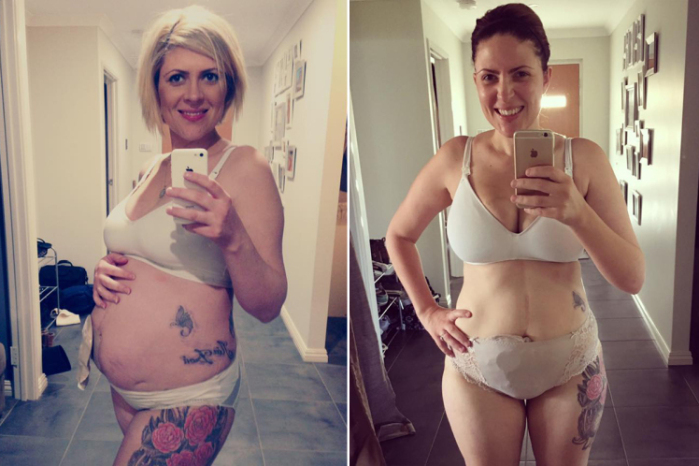 Madre con bolsa de ileostomía motiva a sus pares a amar su cuerpos con sexys fotos