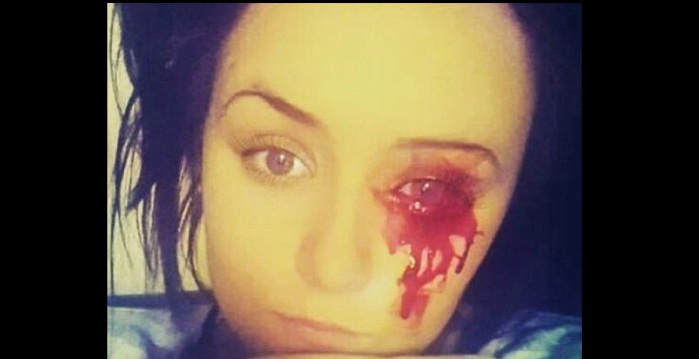 Marnie Harvie: la niña que literalmente llora sangre