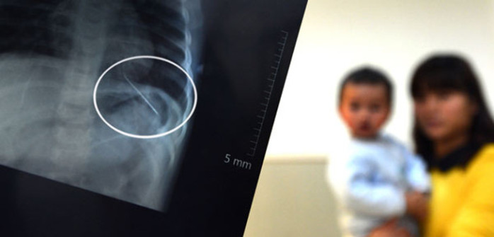 Compleja situación: Niño de 3 años en Angol se tragó aguja y operación es riesgosa