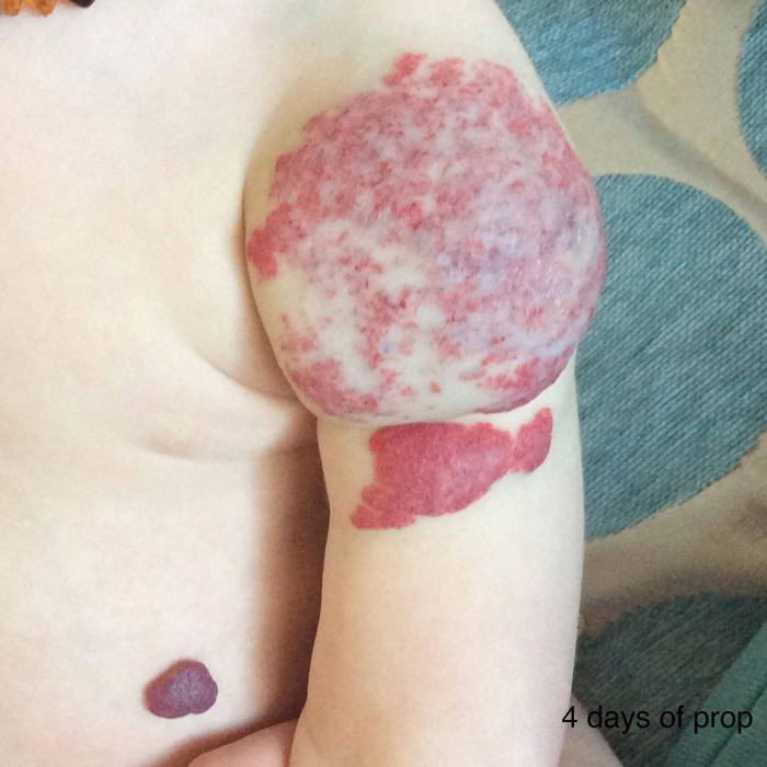 Hemangioma de Lewis | The Sun
