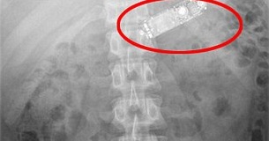 Joven reo se tragó su celular: Tuvieron que operarlo de urgencia