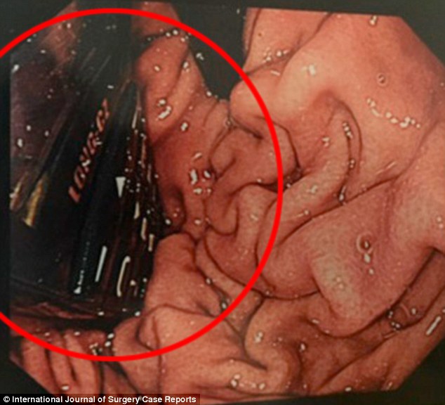 International Journal of Surgery Case Reports