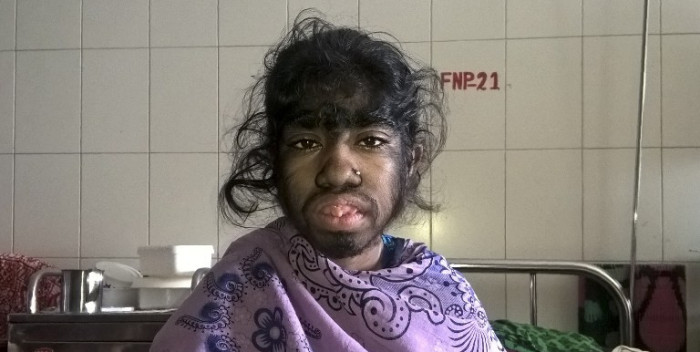 La esperanzadora lucha de niña con síndrome de 