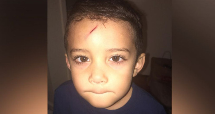 Esto hizo una madre para que su hijo no sienta verguenza de su cicatriz en la frente