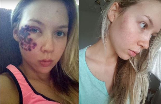 Mamá comida canto Bella bloguera sufre impactantes quemaduras luego de operación con láser |  Sociedad | Página 7