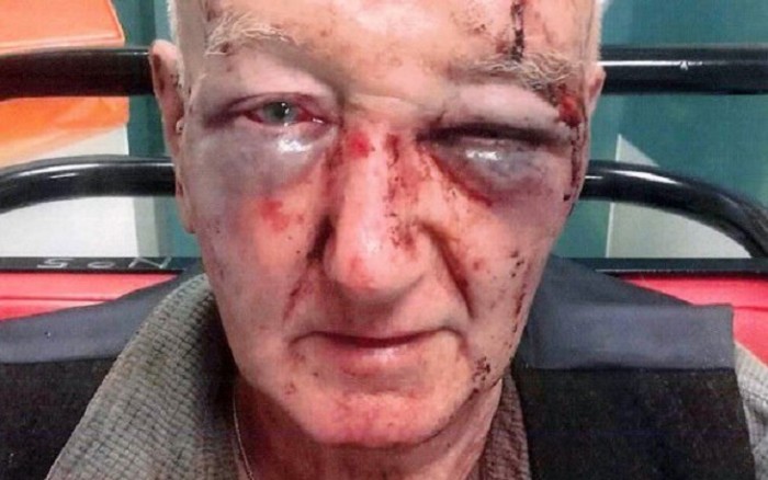 Así quedó el rostro de un anciano tras pedirle a un desconocido que no orinara en su casa