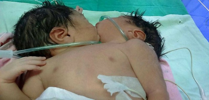 Desgarradora foto muestra a bebés compartiendo un besito: doctor dijo que no sobrevivirán