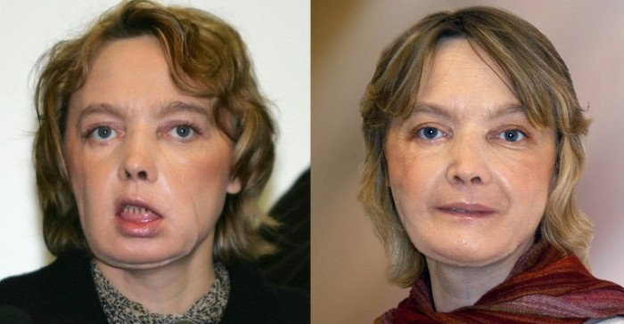 Falleció primera paciente con rostro trasplantado en el mundo