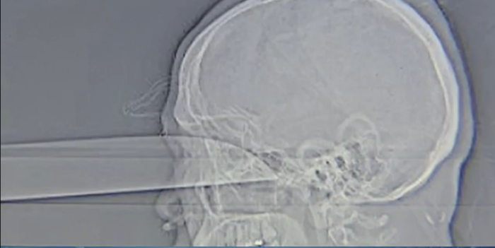 Joven fue apuñalado en el ojo y el cuchillo llegó a su cerebro: sobrevivió y está bien