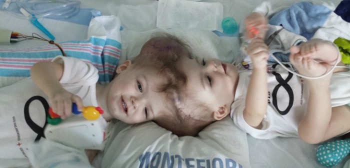 Exitosa operación de unos siameses unidos por la cabeza conmovió a las redes sociales