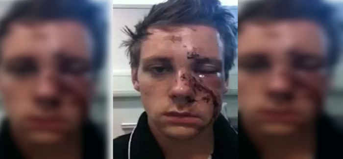 Video muestra increíble recuperación diaria de joven 'desfigurado' tras ataque con botella