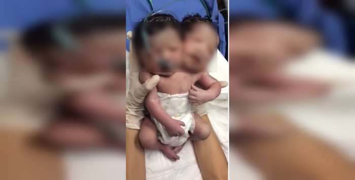 El milagroso nacimiento de 'bebé con dos cabezas' en México
