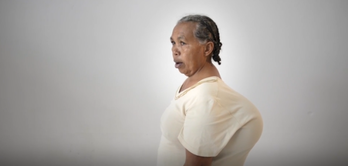 Mariette: la mujer que cargó por 40 años con gigantesco tumor y crueles burlas