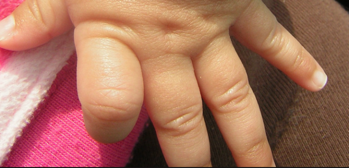 Así luce niña de 2 años que tiene 'piel de pez': terrible condición la deja con escamas