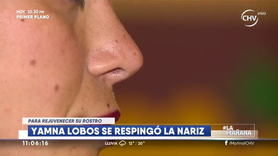Nariz de Yamna Lobos antes de la intervención | CHV