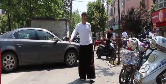Hombre chino vive milagrosamente con piernas 7 veces más grandes de lo normal