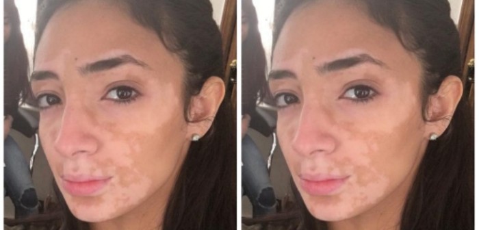 Joven con vitiligo muestra la increíble transformación de su rostro tras maquillarse