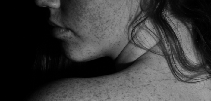 Mujer se enteró que padecía grave enfermedad tras extraña aparición de pecas