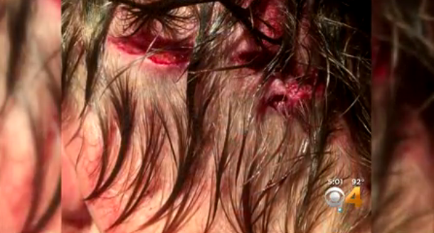 Las heridas | CBS Denver