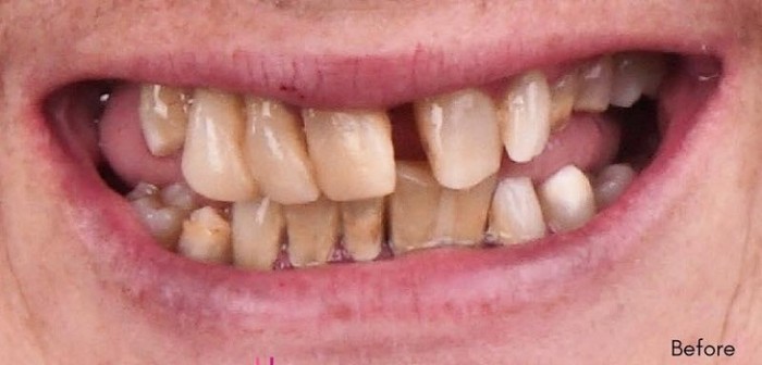 Mujer mostró su antes y después tras evadir por 15 años al dentista: se gastó $23 millones