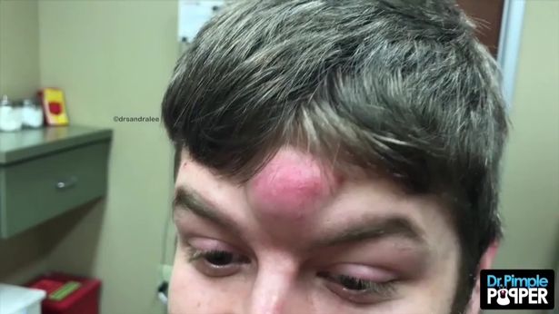 Dr. Pimple Popper