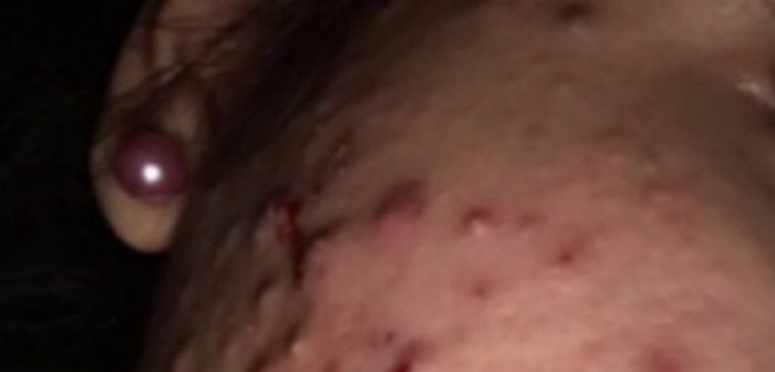 Logró vencer el acné: joven revela el secreto de belleza que cambió su vida