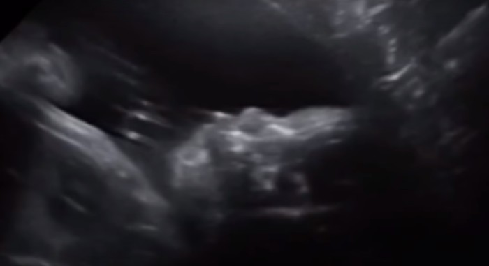 Emocionante sorpresa: bebé de 28 semanas saludó a sus padres a través de una ecografía