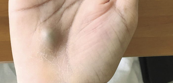 ¡Casi muere! Joven canadiense descubrió raro bulto en su mano tras letal infección dental