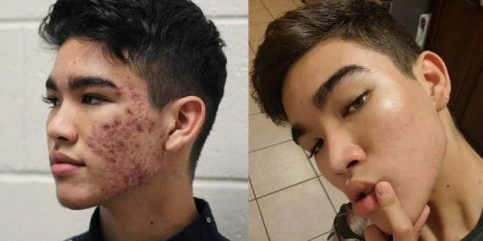 Creó su propio tratamiento: joven sanó su rostro del acné severo siguiendo esta rutina