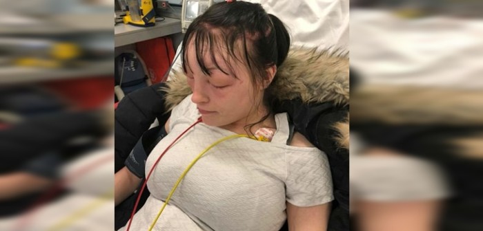 Quiso teñirse el pelo para su cumpleaños y terminó con reacción alérgica en el rostro