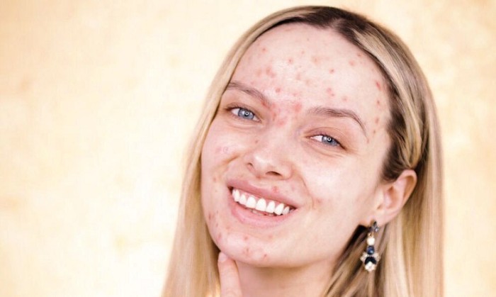 Acné selfie: la tendencia de Instagram que busca la aceptación de las imperfecciones