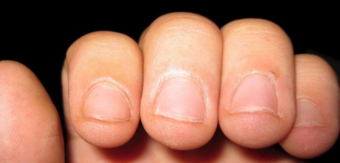 Joven padre estuvo al borde de la muerte por aterrador motivo: comerse las uñas