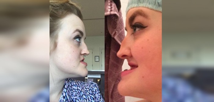 Joven se sometió a drástica operación tras sufrir bullying por su mandíbula