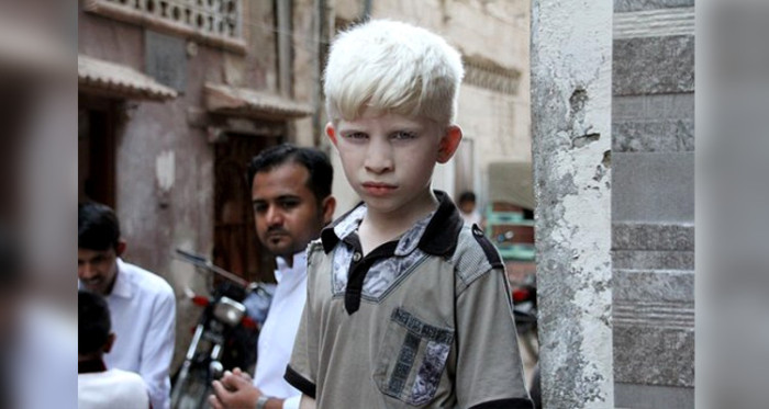 El inédito censo de albinos en Chile con el que se busca derribar mitos sobre ellos