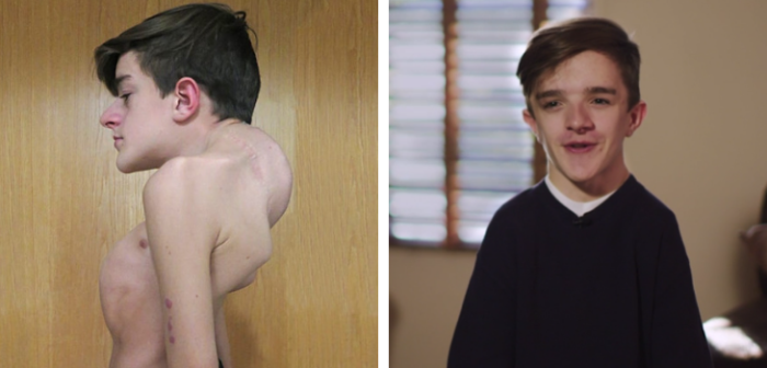 El increíble cambio de vida de adolescente que se sometió a 18 cirugías por su escoliosis