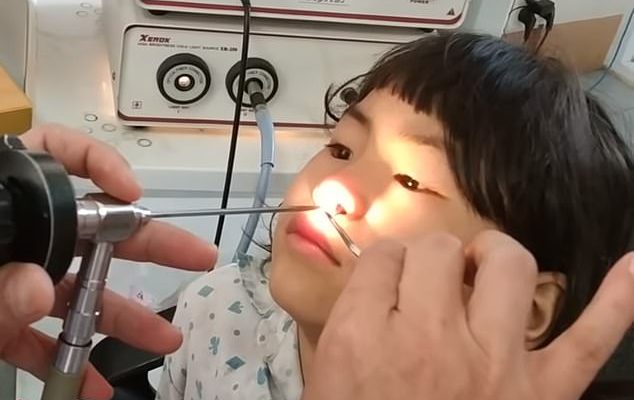 Para no creer: retiran gusano de 7 cm de la nariz de niña tras tenerlo alojado un mes