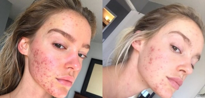 El cambio es evidente: la sencilla dieta con la que modelo eliminó severo acné de su rostro