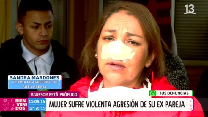 El desgarrador relato de mujer que sufrió brutal agresión de su expareja: “Me desfiguró el rostro”
