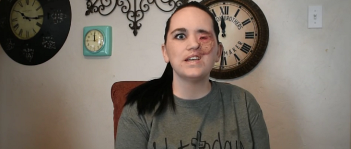 Brittney Sullivan se quemó la mitad de su rostro luego de sufrir un ataque de epilepsia y caer sobre su ondulador de cabello en el baño